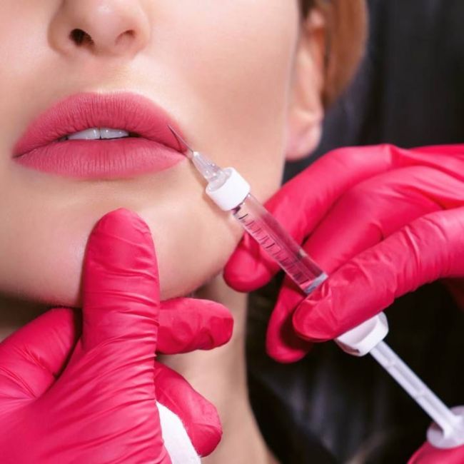 tiêm filler môi