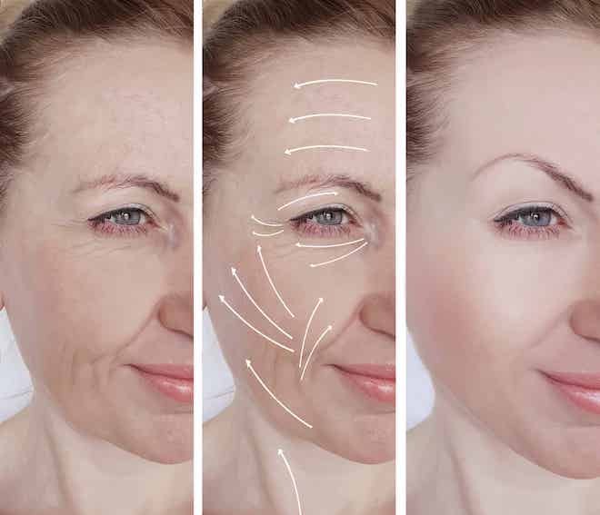 Nâng cơ mặt, nâng cơ thon gọn mặt là một cách quay ngược tuổi xuân cho da 