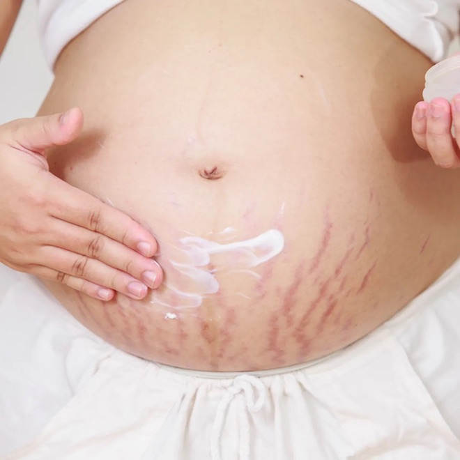 Chế độ chăm sóc trước khi sinh hạn chế tối đa các vết rạn da sau sinh 