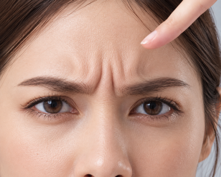 ấn đường có nếp nhăn