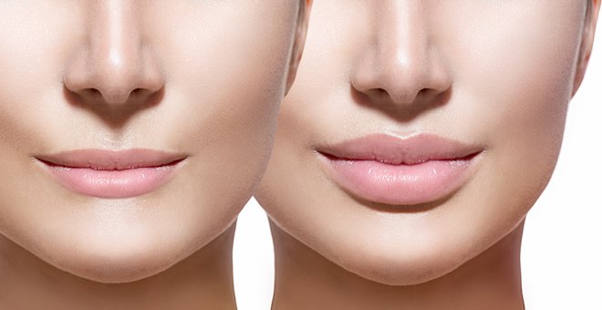 Tiêm môi kiêng gì để giữ đúng dáng môi và hạn chế biến chứng sau tiêm