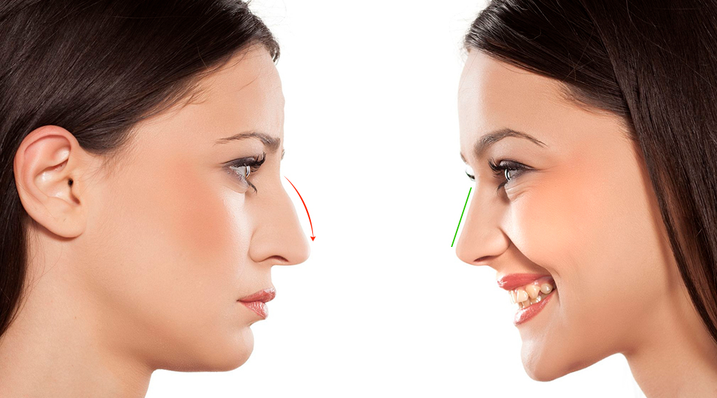 Nâng mũi chỉ collagen có vĩnh viễn không?