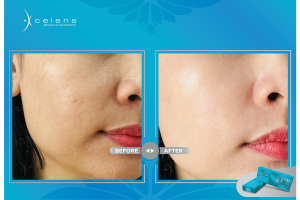 giá tiêm meso căng bóng