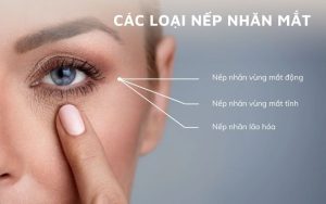 giảm nếp nhăn mắt