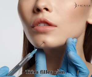 giá tiêm filler cằm