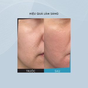 tiêm meso bao lâu thì đẹp