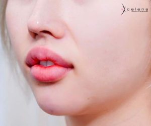 cách làm tan filler vón cục