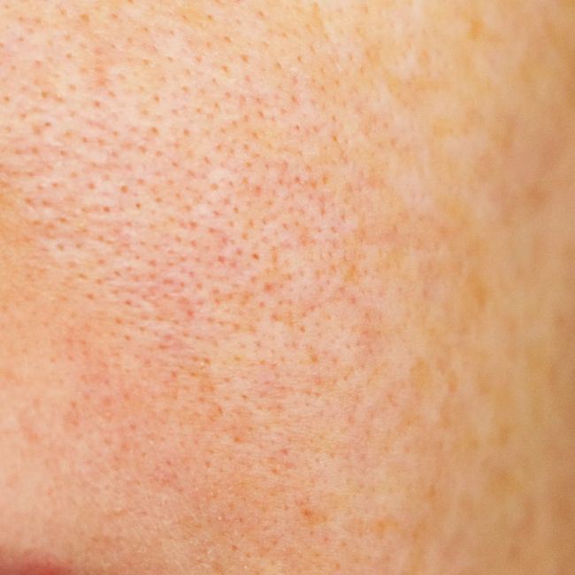 Giãn Nở Lỗ Chân Lông – Dấu Hiệu Cảnh Báo Làn Da Đang Lão Hóa