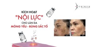 Da nhiễm corticoid và bùng sắc tố