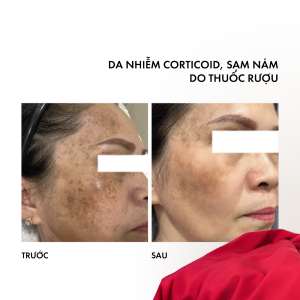 Kết quả lâm sàng sau khi phục hồi da với Xcelens