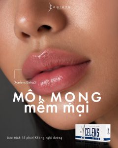 Sản phẩm filler môi từ Xcelens