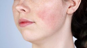 meso phục hồi da