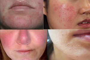 Da nhiễm corticoid