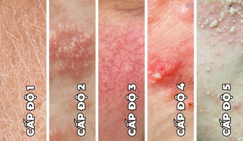 Da nhiễm corticoid