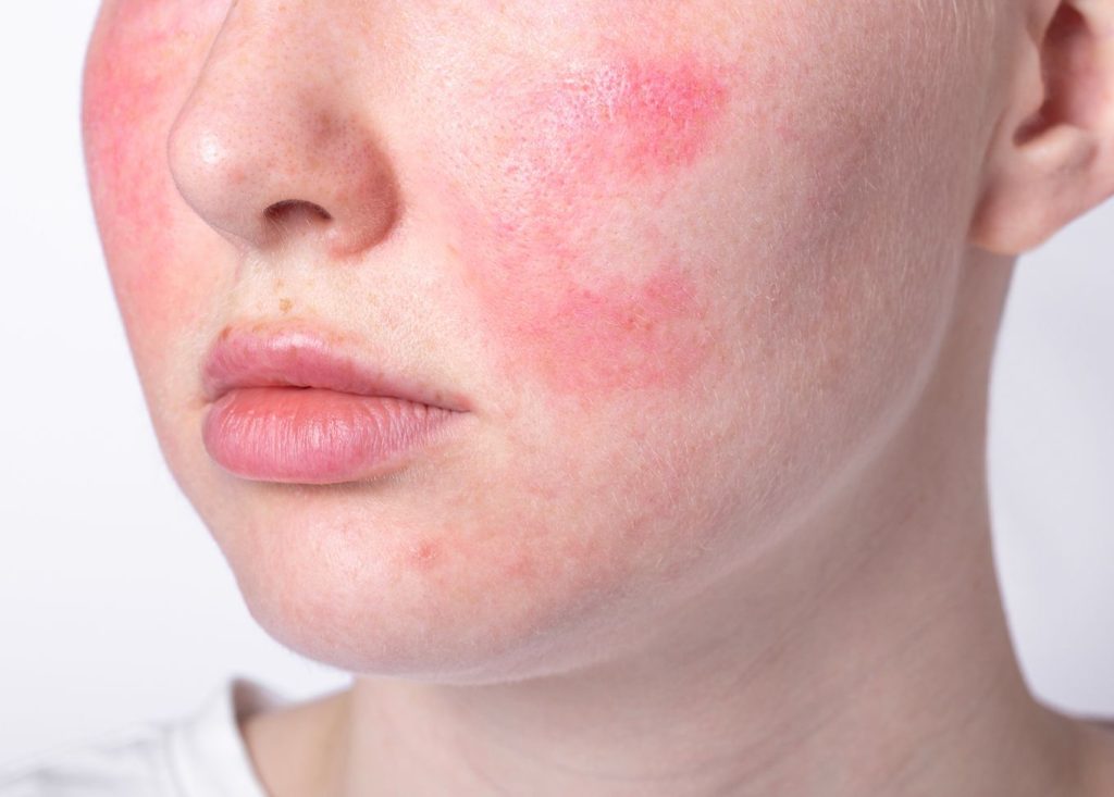 Da nhiễm corticoid