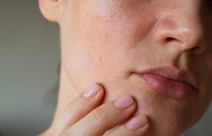 Da nhiễm corticoid