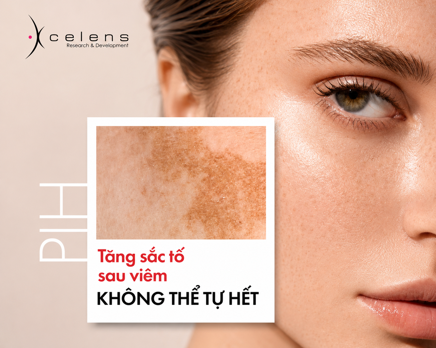 Tăng sắc tố sau viêm (PIH): Vì sao kéo dài và khó cải thiện?