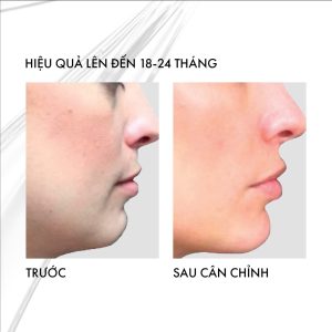 Hiệu quả lâm sàng sau khi căn chỉnh cằm