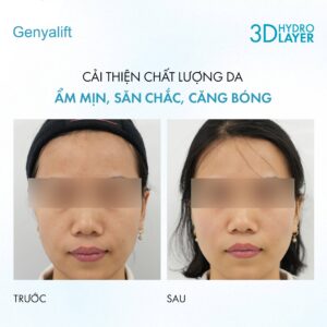 Lâm sàng genyalift