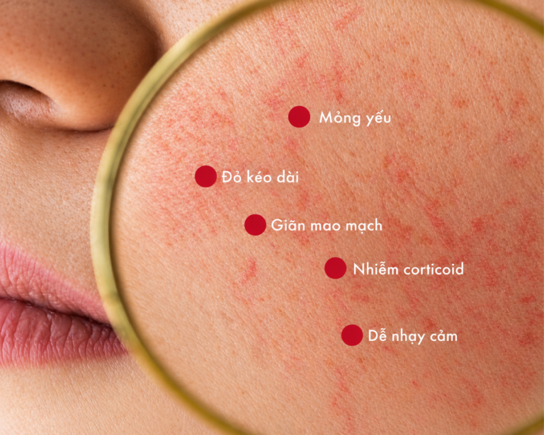 tiêm meso cho da nhạy cảm